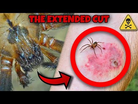 BROWN RECLUSE BITE? What happens? THE EXTENDED CUT!