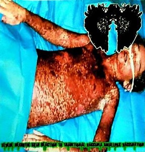 Carcinomas Of Unknown Primary Origin - Severe Necrotic Skin Reaction To Traditional Vaccinia Smallpox Vaccination