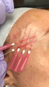 New AAFE Exclusive Solid Filler PDO Threads for filling in the...