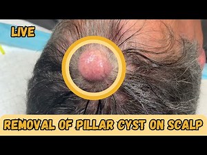 Removal of a Decent-Sized Pilar Cyst on the Scalp: Step-by-Step Procedure