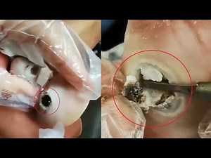 Surgery to Remove Large Plantar Warts | How To Treat Plantar Warts