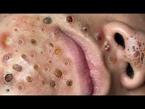 Loan Nguyen Acne Treatment 37tt