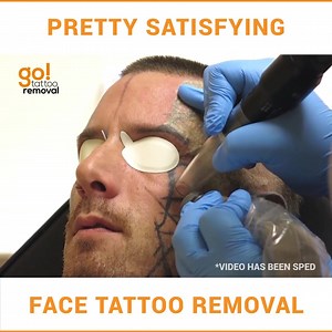 This face tattoo removal is pretty satisfying to watch...! By: Providr Via: GO! Tattoo Removal Find out more: http://bit.ly/2vAq1Ng | InkSpired Magazine