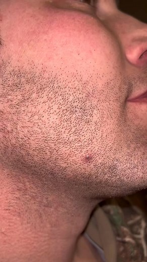 Transform Your Look Instantly! 🌟 Watch Our Ultimate Mustache Removal Guide Using Tweezers for a Smooth Finish! 🚀✨ #smoothlook #confidenceboost #selfcare #groomingtips #beautyhacks #skincareroutine #facialhair #mustacheremoval #mengrooming #beautyroutine #lookgoodfeelgood #mustachefree #personalcare #hairremoval #glowup #beautytips #selflove | April-09-04