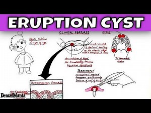 Eruption cyst - Pathogenesis, Clinical and Histopathologic features
