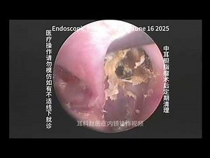 Postoperative cleaning of cholesteatoma of the middle ear 20250616