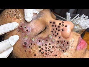 Deep Cleaning Clogged Pores on Nose Sides
