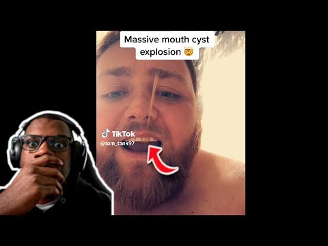 THE CYST EXPLODED IN HIS MOUTH!😱 | Pimple popping and Blackhead Compilation