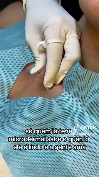 Microdermal Piercing Application Process Explained