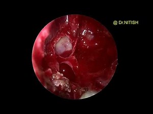 Endoscopic Pituitary surgery --Transsphenoidal Approach
