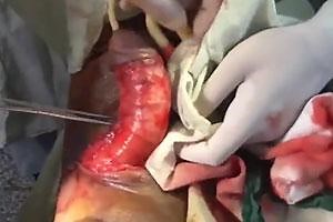 Fixing Degloved Penis