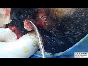 Scarless 20_ Year old Pilar Cyst