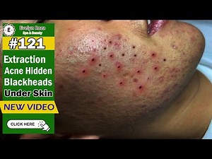 Removal Blackheads under skin For Male | acne treatment 121