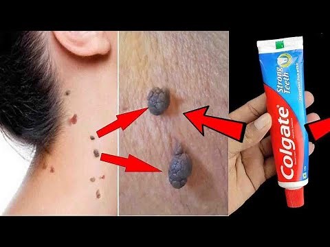 Remove Skin Tags In 1 Night | 2 Amazing Remedies For Skin Tags Removal | How To Remove Skin Tags