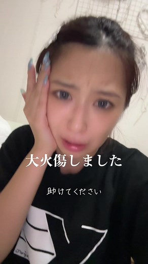 緊急！やけどの処理法と注意点