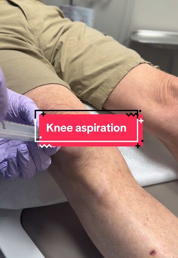 Knee Aspiration Procedure for Prepatellar Bursitis Relief