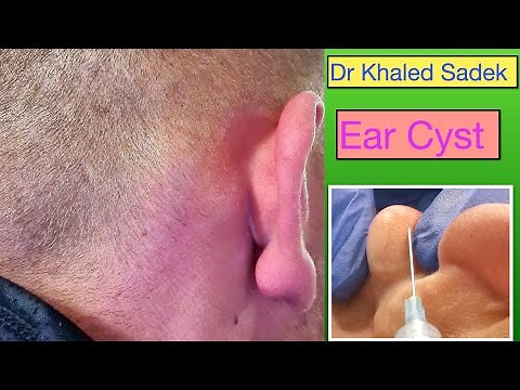 Ear-Cystable! Great big ear cyst. Dr Khaled Sadek. LipomaCyst.com