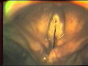 Muscle Tension Dysphonia, by Rammage, Morrison, Nichol