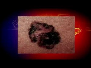 Mole or Skin Cancer