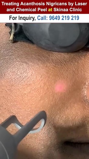 Treating Acanthosis Nigricans by Laser and Chemical Peel at Skinaa Clinic #treatingacanthosis #chemicalpeel #peel #chemical #skinaa_clinic #skinaaclinic #reels #viral #foryou | Skinaa - Skin, Laser, and Hair Transplant Clinic