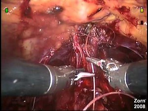 Robotic Radical Prostatectomy - STEP 4- Dorsal Venous Complex (DVC) Suture Control • Video • MEDtube.net