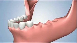 Different options for replacing several missing teeth | Modern Dental Care Mauritius