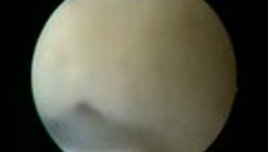 Anatomical single bundle acl reconstruction using hamstring graft