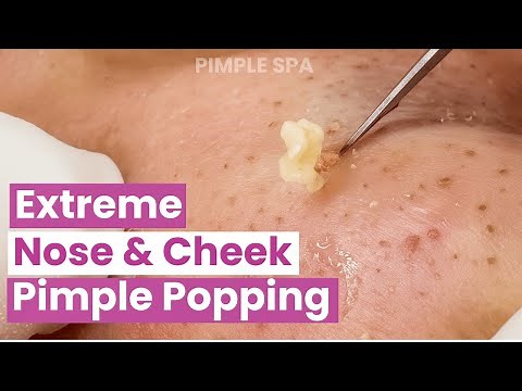 Extreme Nose & Cheek Pimple Popping – Satisfying Deep Extraction ASMR