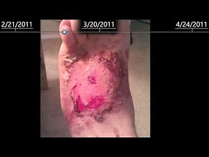 2nd Degree burns on foot - healing time lapse - 2 months