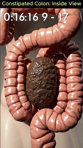 What Constipation Really Looks Like: Realistic 3D Colon Footage You’ve Never Seen | 15