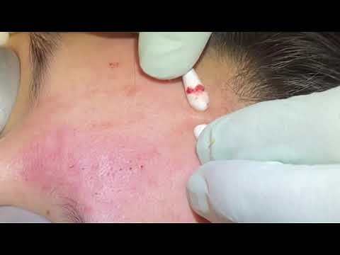 Favorite extractions #6. Blackheads, whiteheads, juicy pore pops. Q-tip removals. Waxy plugs cleared