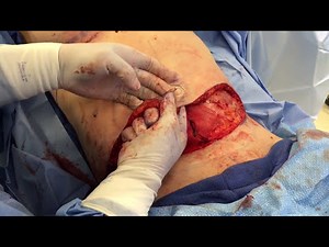 Mommy Makeover Live Surgery - breast augmentation and tummy tuck ( abdominoplasty ) Phillip Chang MD