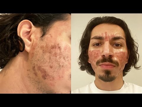 CO2 Laser Treatment for Acne Scars