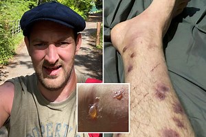 Dad suffers horrific 3rd degree burns after brushing against toxic Giant Hogweed