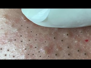 Huong Da Nang Acne Treatment #278