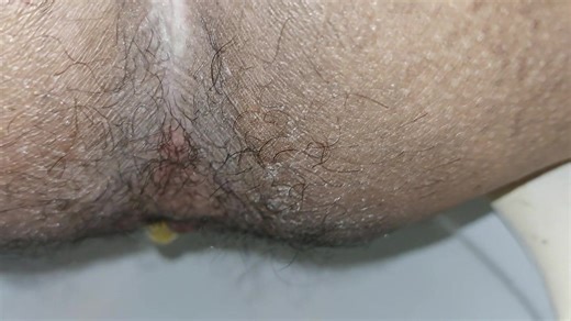 Quick watery diarrhea with farts