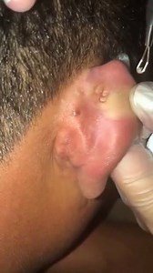 Satisfying behind the ear pops much blackheads😱 | Pimple Popping, Cyst and Blackhead