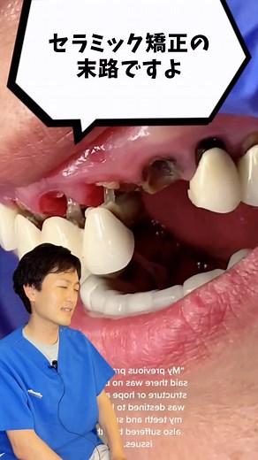 セラミック矯正のリスクと虫歯の危険