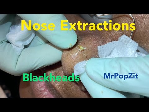 Nose extractions. Blackheads. Whiteheads . DPOW. Pore dirt cleared. Pop talk. Fun patient. MrPopZit