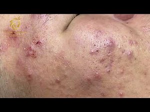 Blackheads extraction (403) | Loan Nguyen