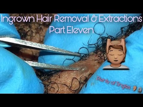 ASMR Ingrown Hair Removal & Extractions 11 🔍| Beard & Neck Area