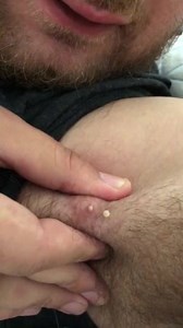 OMG!!! Best pimple pop 😲😲😲 | Pimple Stuff