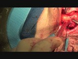 Rectocele Repair - Transvaginal Technique with Mesh and Levatorplasty • Video • MEDtube.net