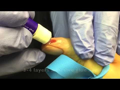 Finger Tip Avulsions