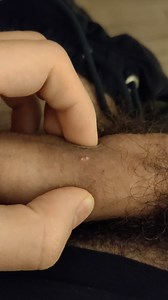 peculiar penis pimple pops
