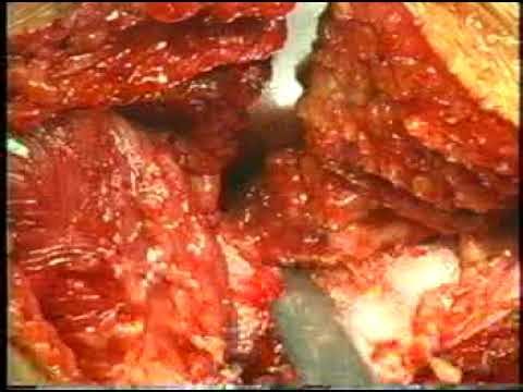 Watson-Jones approach in total hip arthropalsty by KYM