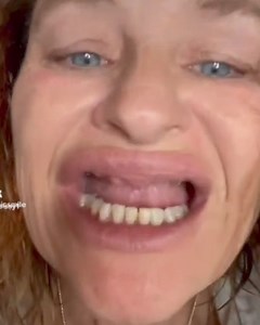 Dental Costs Got You Down? All-on-4 Implants for Only $8,999 at Bionic Smile. Quality, Guaranteed. | Bionic Smile