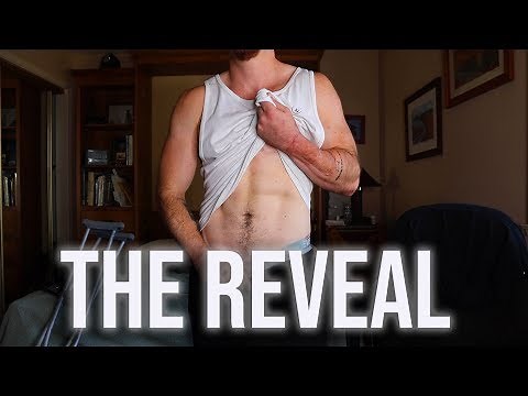 FTM Phalloplasty Revealing My Results