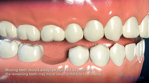 Dental Implant Consent Video | جامعة المنارة Almanara University