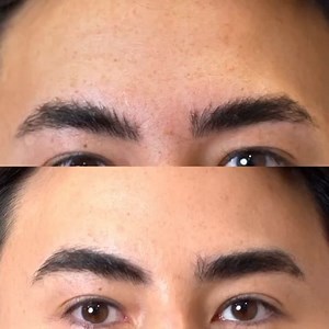 Anti-Wrinkle Injections not only remove unwanted lines, they prevent any further lines & wrinkles from forming💜 #Transformation #AntiWrinkle #TherapieClinic #DoctorLed #MedicalClinic | Thérapie Clinic UK